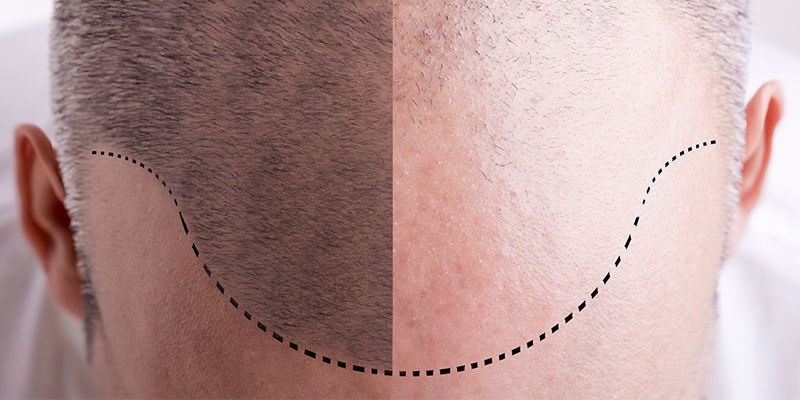 DHI Hair Transplant