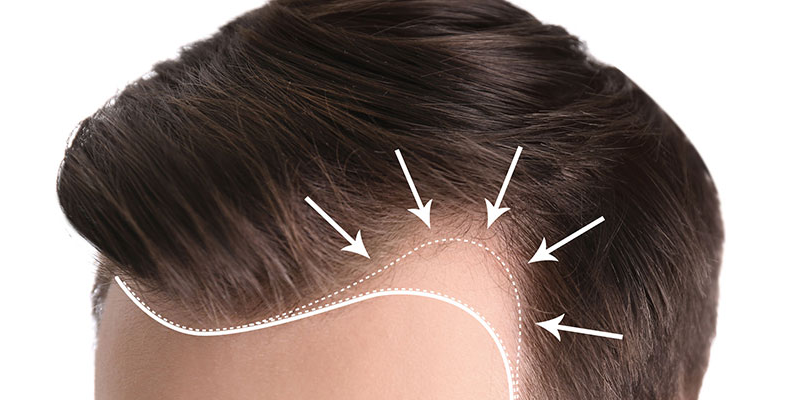 FUE Hair Transplant