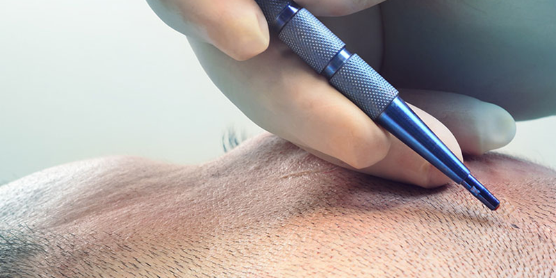 Sapphire Hair Transplant