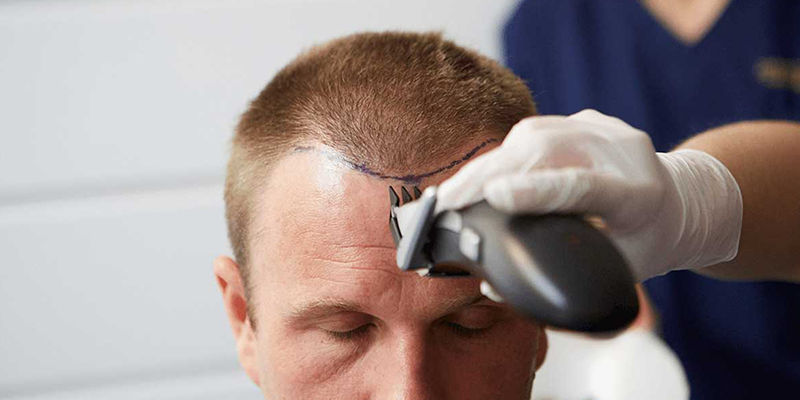Unshaven Hair Transplant
