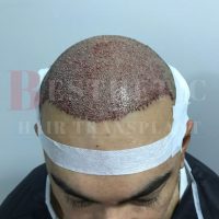 hair-transplantation-patient-references_1 hair-transplantation-patient-references_1