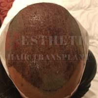 hair-transplantation-patient-references_12