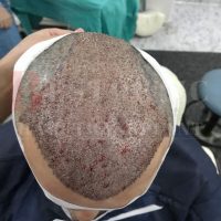 hair-transplantation-patient-references_13 hair-transplantation-patient-references_13