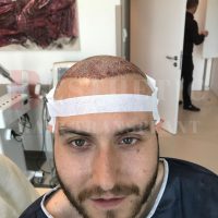 hair-transplantation-patient-references_14 hair-transplantation-patient-references_14