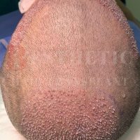 hair-transplantation-patient-references_15 hair-transplantation-patient-references_15