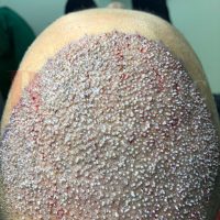 hair-transplantation-patient-references_16 hair-transplantation-patient-references_16