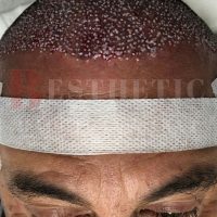 hair-transplantation-patient-references_17 hair-transplantation-patient-references_17