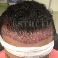 hair-transplantation-patient-references_18 hair-transplantation-patient-references_18