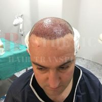 hair-transplantation-patient-references_19 hair-transplantation-patient-references_19