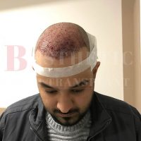 hair-transplantation-patient-references_2 hair-transplantation-patient-references_2