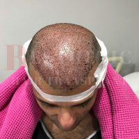 hair-transplantation-patient-references_20 hair-transplantation-patient-references_20