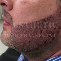 hair-transplantation-patient-references_23 hair-transplantation-patient-references_23