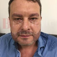 hair-transplantation-patient-references_25 hair-transplantation-patient-references_25