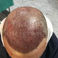 hair-transplantation-patient-references_4 hair-transplantation-patient-references_4
