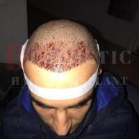 hair-transplantation-patient-references_5 hair-transplantation-patient-references_5