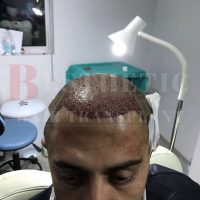 hair-transplantation-patient-references_7 hair-transplantation-patient-references_7