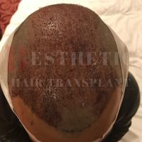 hair-transplantation-patient-references_8 hair-transplantation-patient-references_8